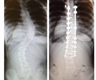 Scoliosis patient returns to gymnastics after surgery