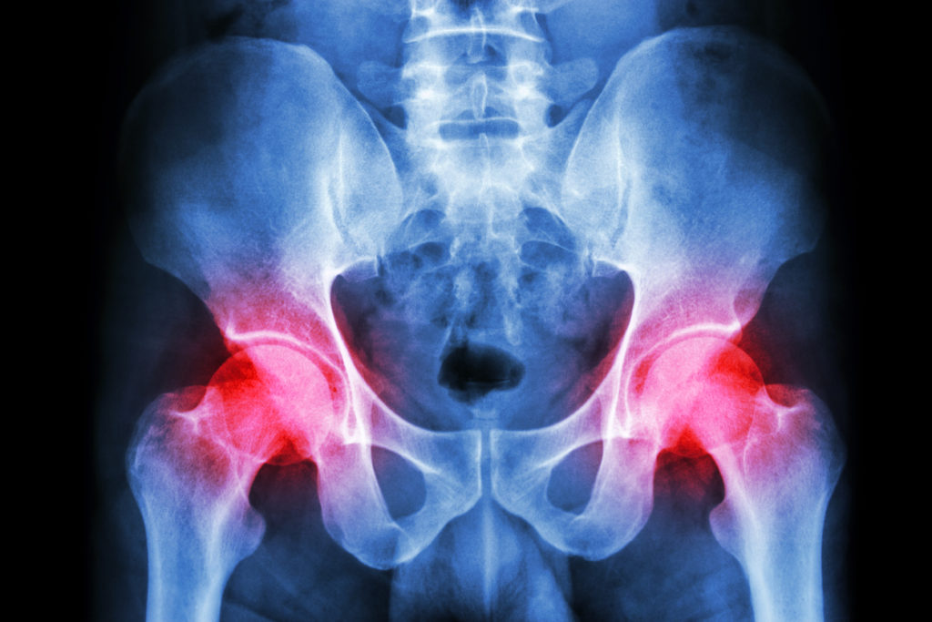 What is hip bursitis? | OrthoIndy Blog