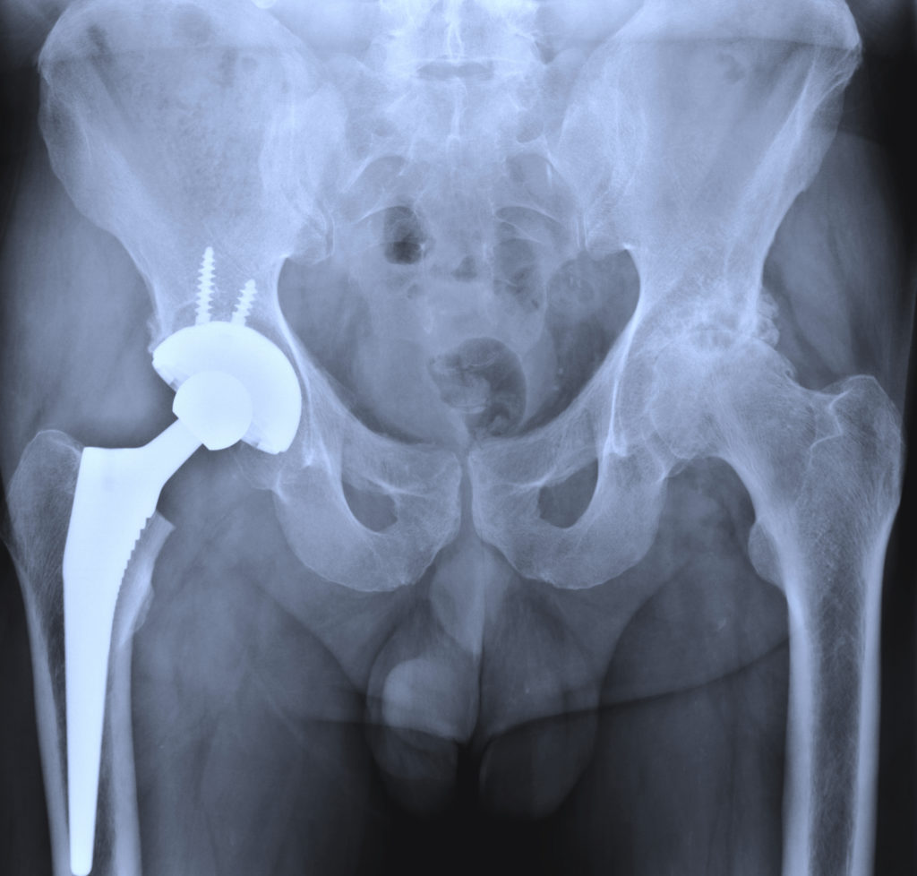 Xray Of Total Hip Arthroplasty Stock Photo - Download Image Now