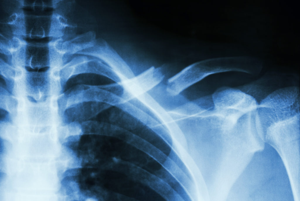 Broken collarbone: Symptoms and recovery