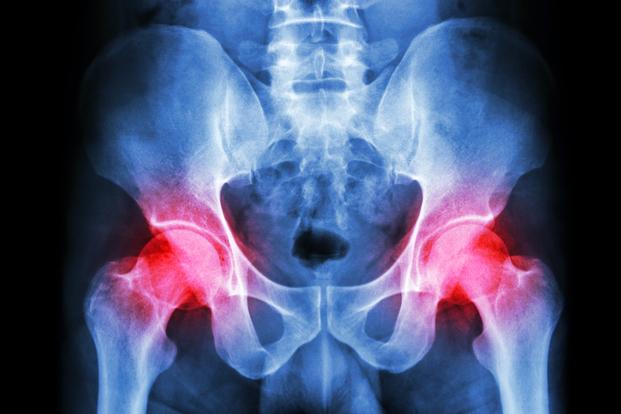 Trochanteric hip bursitis