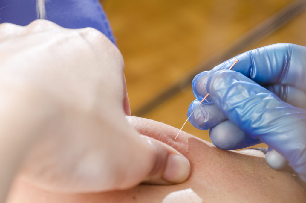Dry needling now offered at OrthoIndy