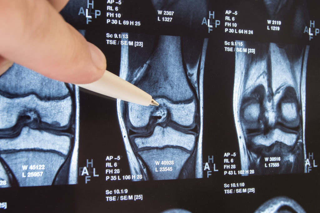 Partial knee replacement vs. total knee replacement