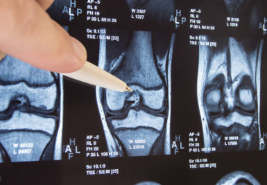 partial knee replacement reviews