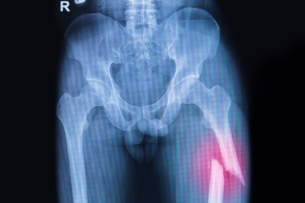 femur fracture anatomy