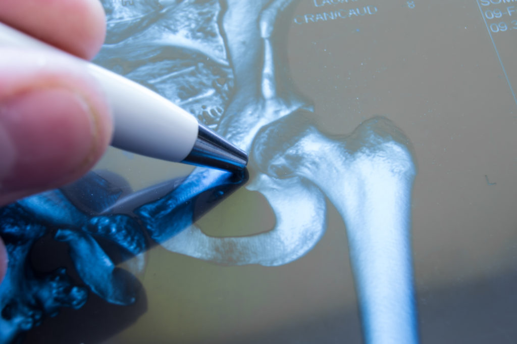 What causes slipped capital femoral epiphysis?