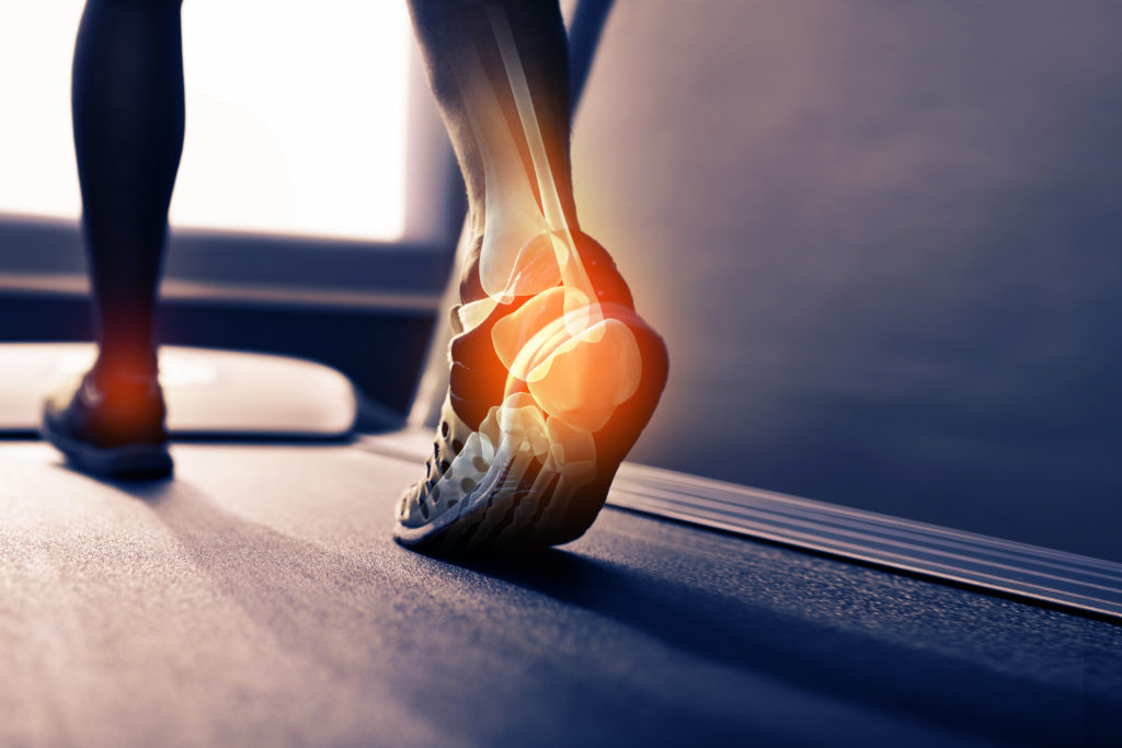 How do you treat a fractured heel bone (calcaneus fracture)?