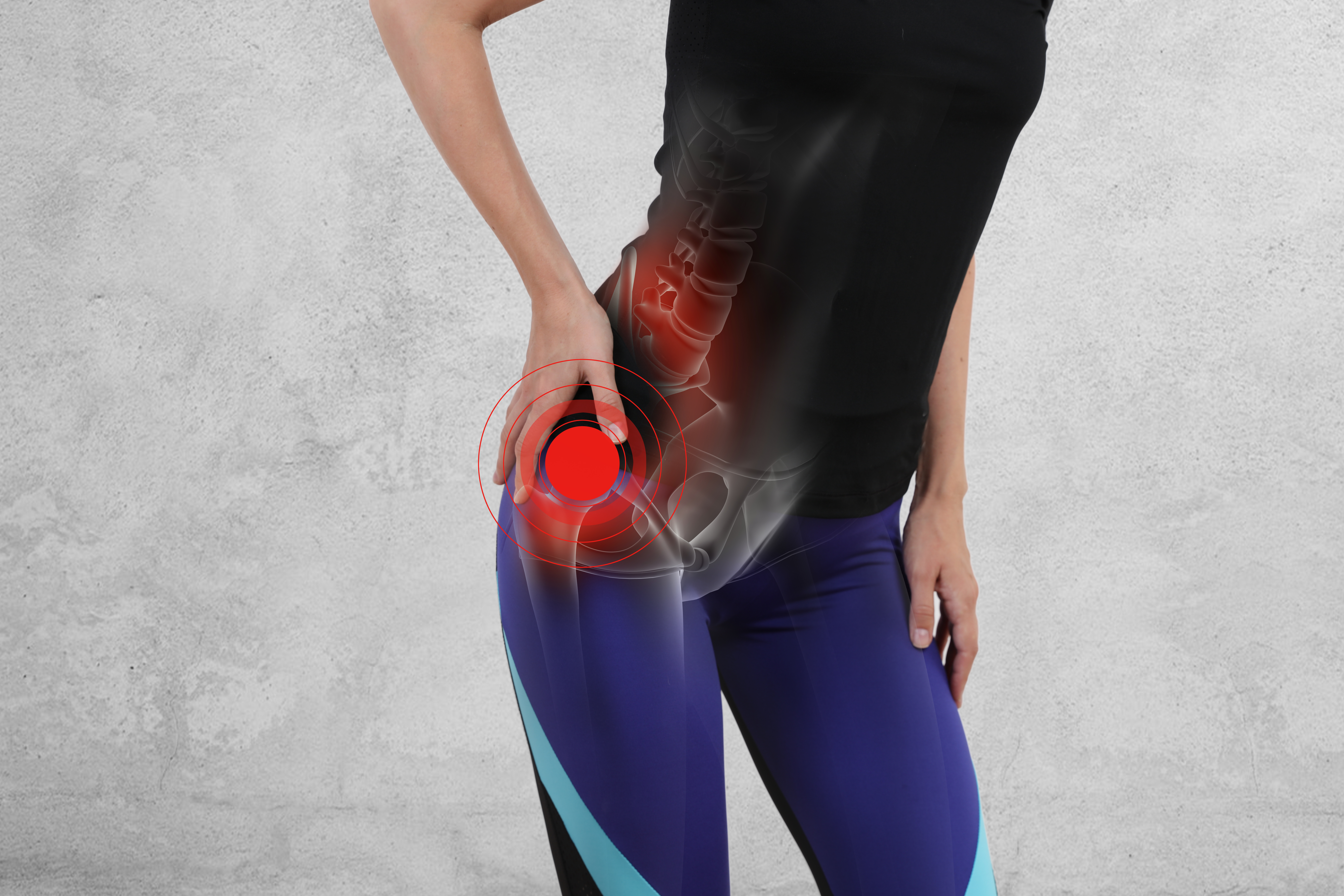 What is hip impingement?