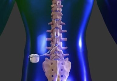 Spinal cord stimulation as a treatment for back pain