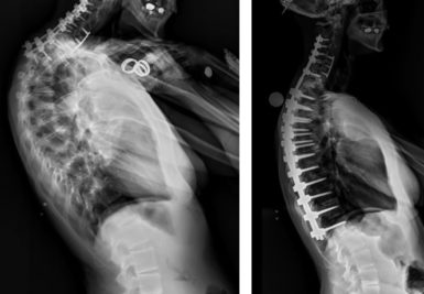 Before and after X-ray images of a spinal fusion and osteotomy surgery
