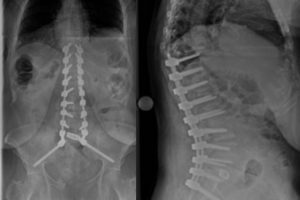 Before and after spinal fusion