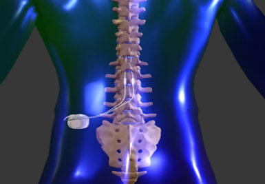 Spinal cord stimulation as an alternative to back surgery
