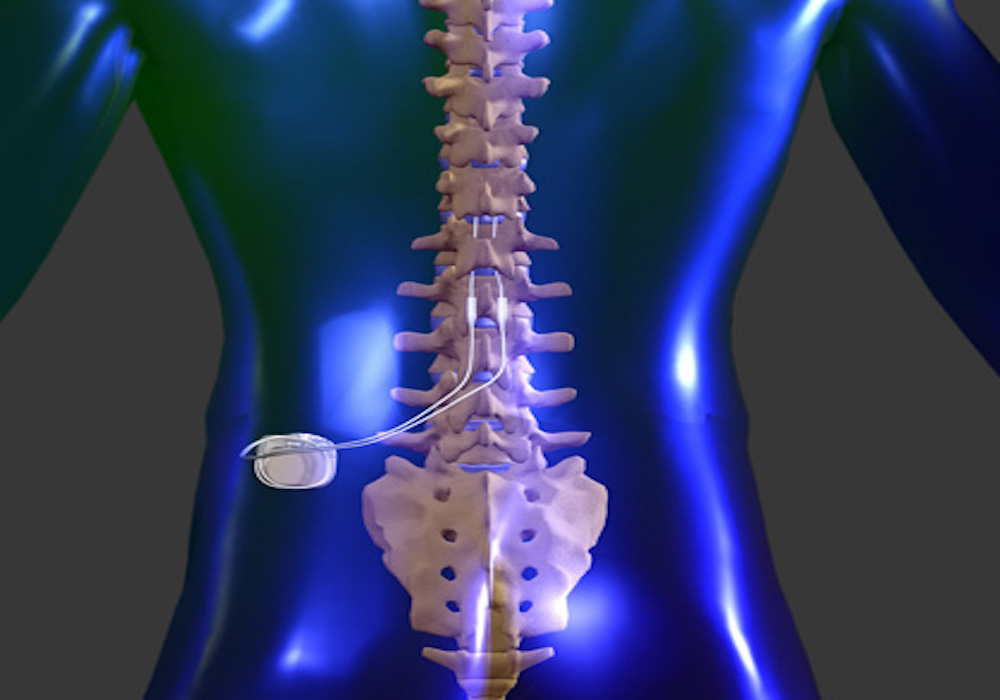 Safer alternative to opioids: Spinal cord stimulator for back pain relief