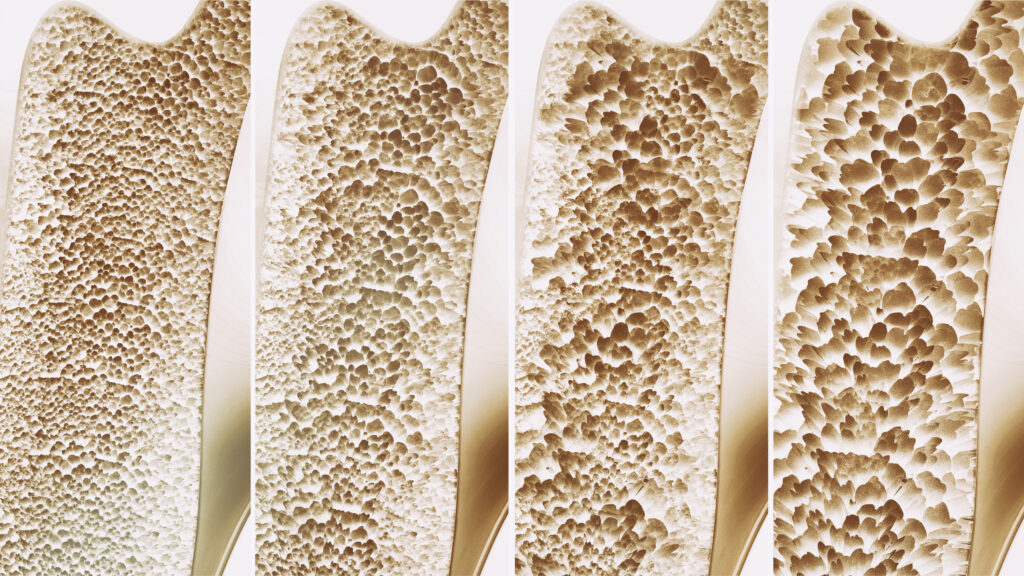 Simple Steps You Can Take to Prevent, Detect and Treat Osteoporosis