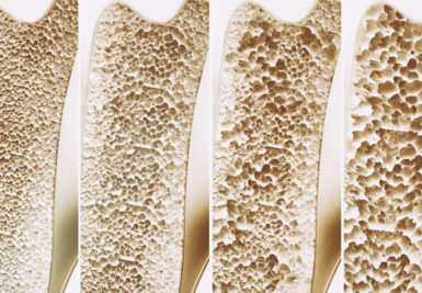 Steps You Can Take to Prevent, Detect and Treat Osteoporosis